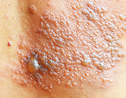 대상포진으로 인해 피부에 발생한 수포